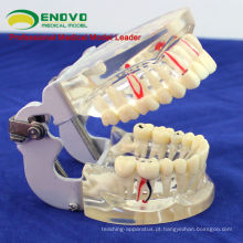 DENTAL07 (12566) Modelo adulto transparente dos dentes patológicos para o estudo dental e a comunicação